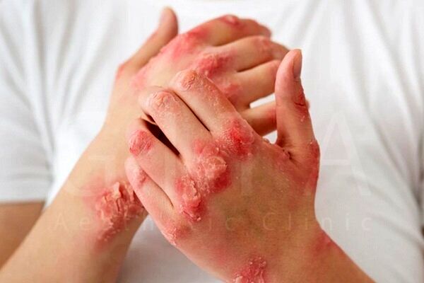 بیماری پسوریازیس چیست؟