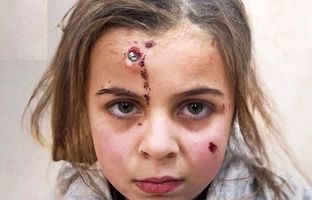 خونسردی عجیب دختربچه فلسطینی با ترکش در پیشانی + ویدئو