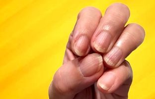 خطوط عمودی یا افقی روی ناخن‌ها علامت چیست؟