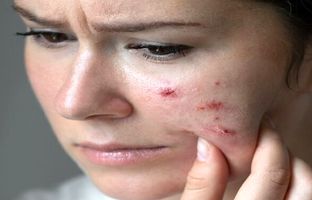 جوش‌های صورت چگونه زندگی را تهدید می‌کنند؟