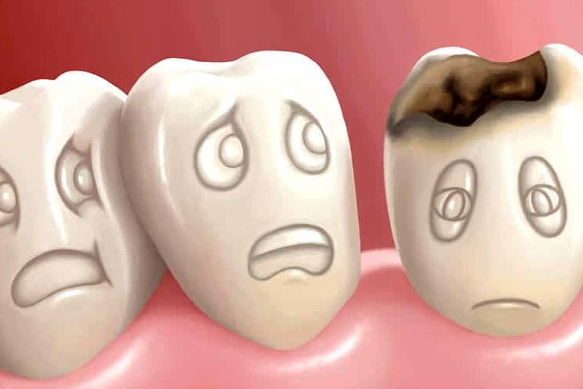 چرا دندان‌ها زود به زود پوسیده می‌شوند؟