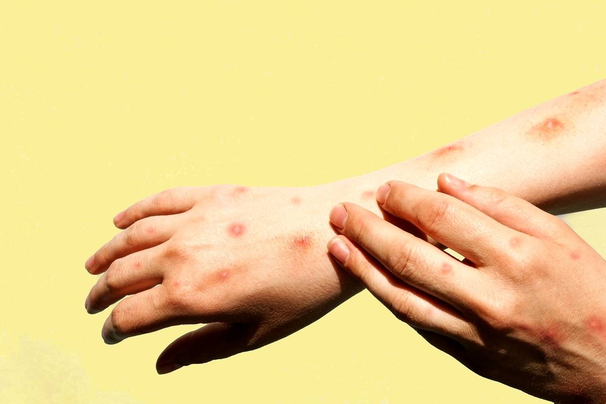 مینو محرز: یک سال‌ونیم پیش بیمار مبتلا به آبله میمونی داشتم