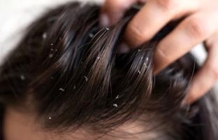 فقط بعد از یک روز، موهایتان چرب می شود؟ علت‌های اصلی که احتمالا نادیده می‌گیرید 