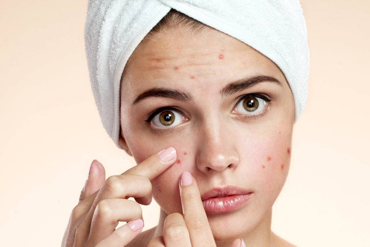 بهترین کرم های ضد جوش و آکنه خارجی
