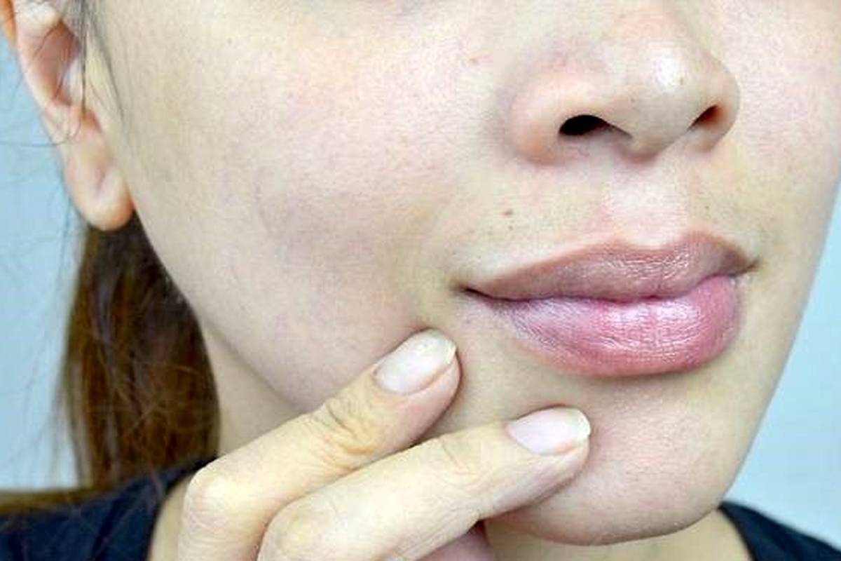 علل و بهترین راههای خانگی درمان سیاهی پشت لب + ماسک گیاهی