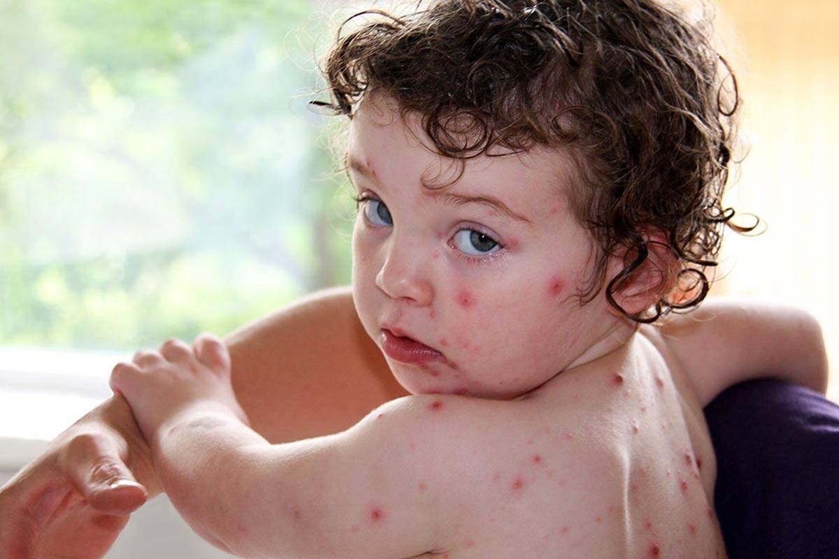 علائم آبله مرغان تا چند روز واگیر دارد و چطور جلوگیری کنیم؟