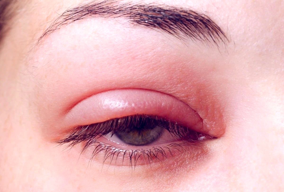 گل مژه چیست و آیا خطرناک است؟ علل، نشانه‌ها و راه‌های درمان آن