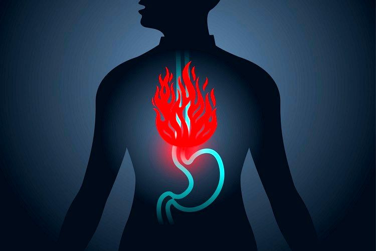 رفلاکس معده چیست؟ علت، علائم و راه‌های درمان اسید معده