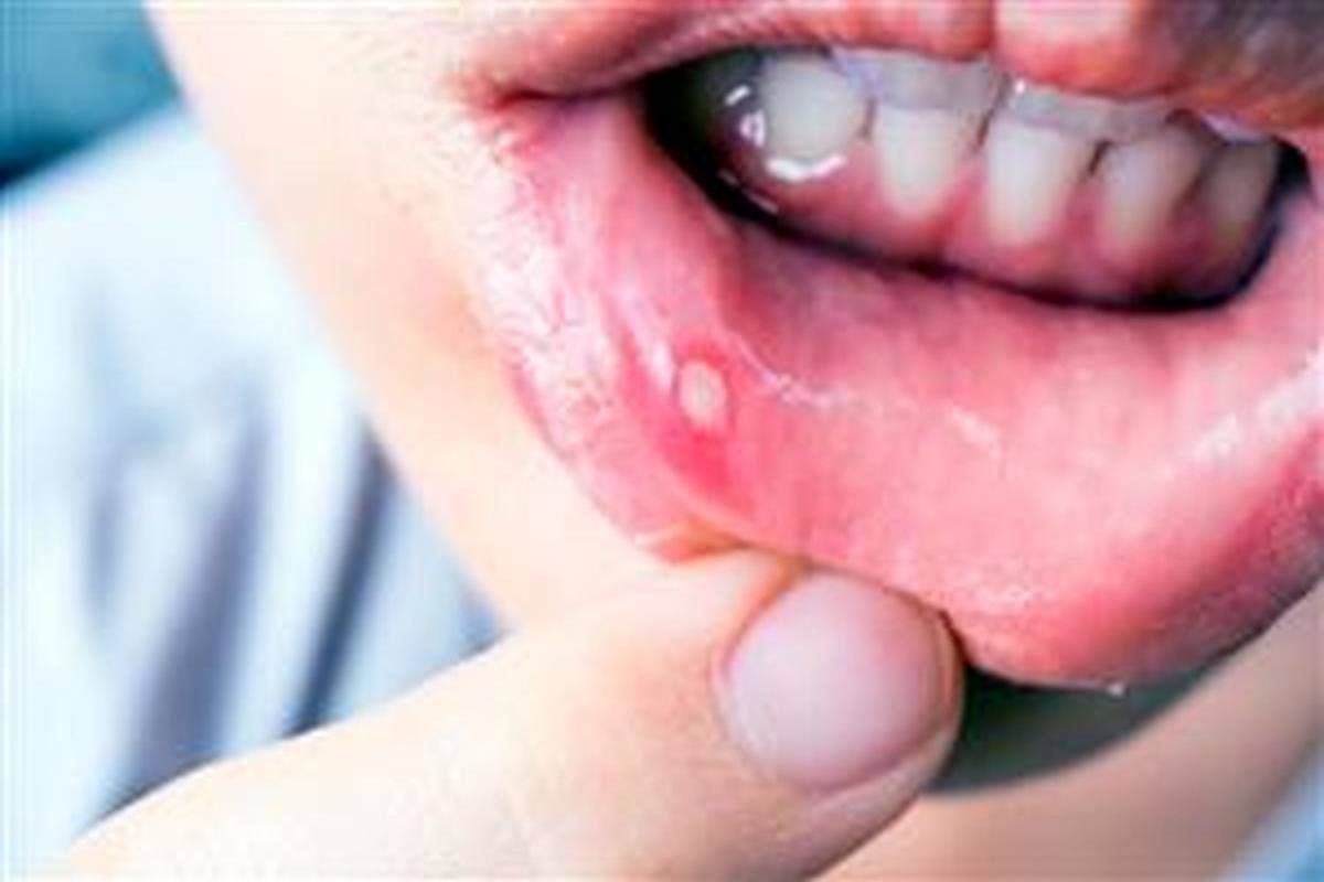 چرا آفت دهان میزنیم و چگونه آن را درمان کنیم؟