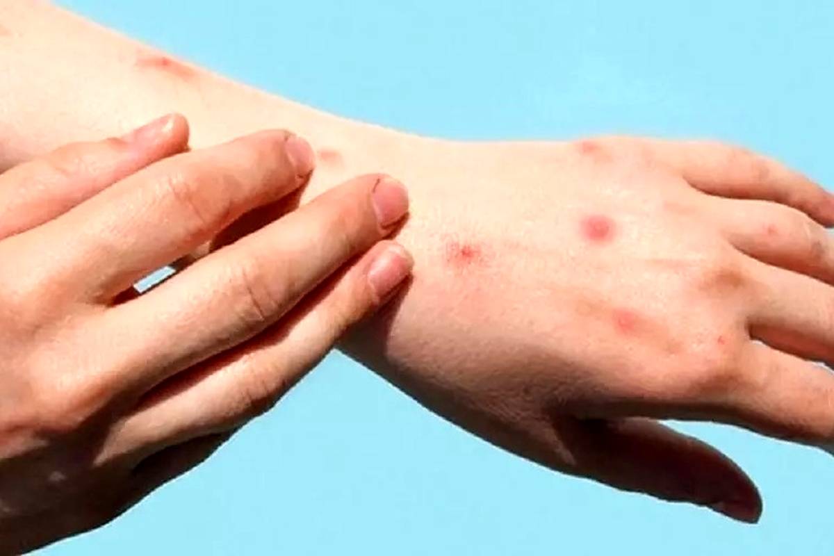 راهکارهای پیشگیری از ابتلا به آبله میمونی