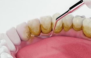 راهکار‌های پیشگیری از تشکیل جرم دندان + ویدئو