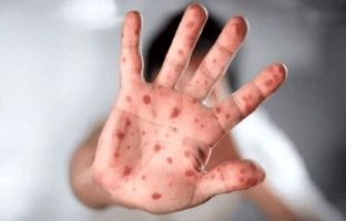 آبله میمون چیست؟ همه چیز درباره این بیماری ویروسی