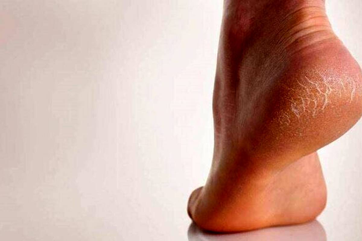 بهترین روش های سنتی برای درمان ترک پاشنه پا