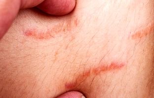 ترک‌های پوستی؛ علل و راه‌های درمان آن