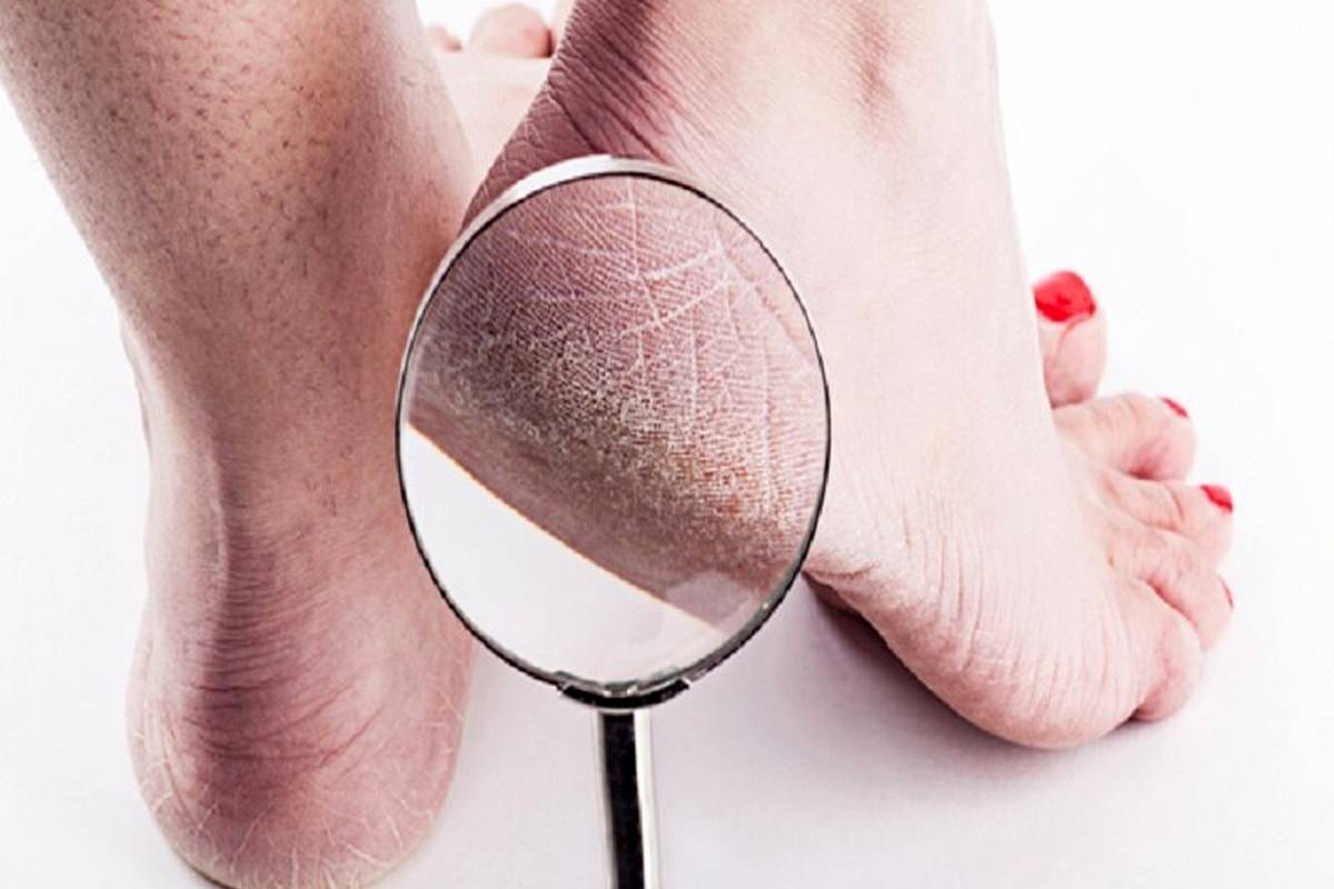 کمبود کدام ویتامینها سبب ترک پاشنه پا میشود؟