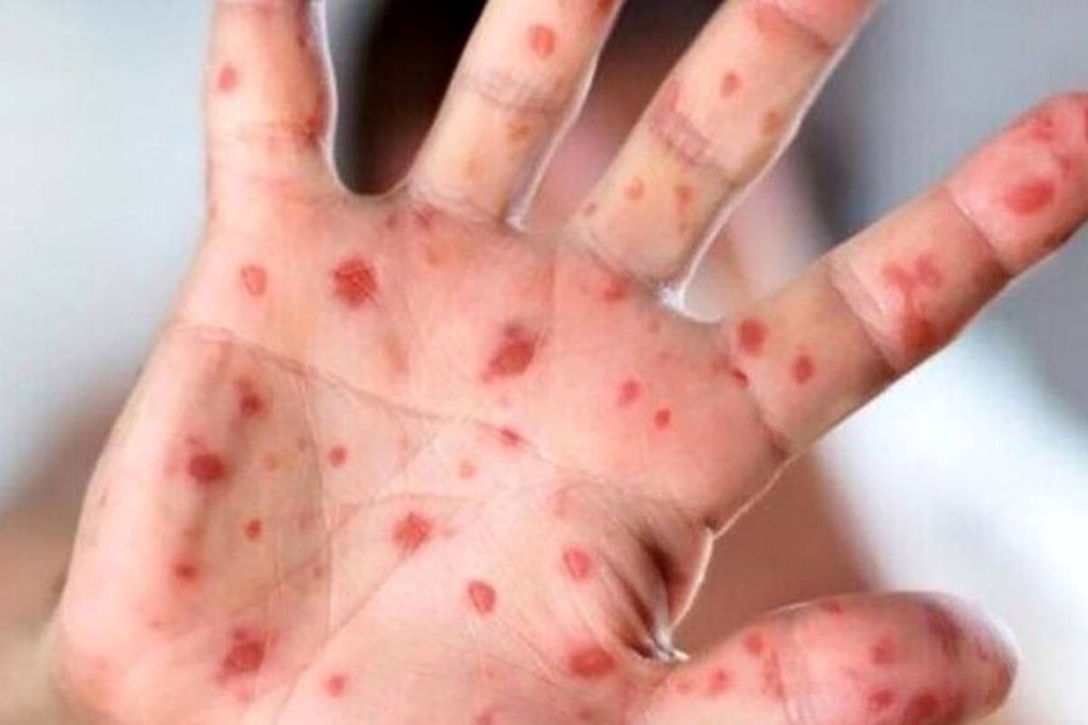 شیوع بیماری واگیردار در کشور؛ اگر واکسن نزنید تا ۹۰ درصد منتقل می‌شود