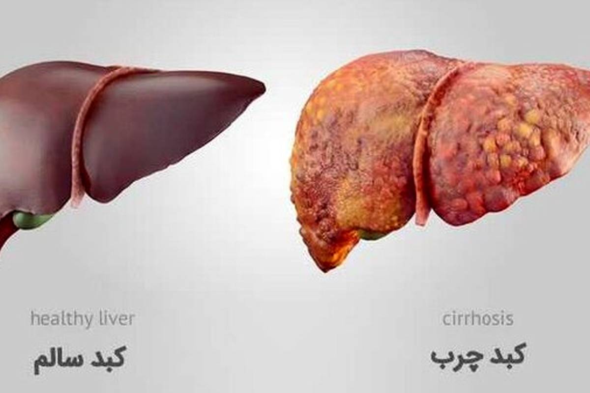 خوراکیهای مفید و مضر برای کبد را بشناسید