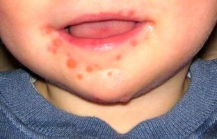 شیوع بیماری دست و پا و دهان در تهران